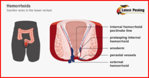 Hemorrhoids