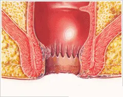 hemorrhoids