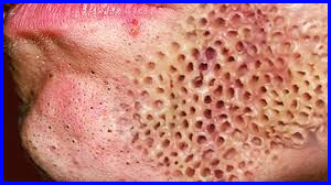 worm trypophobia skin
