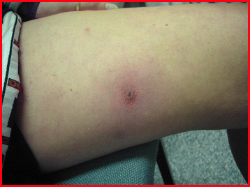 worm trypophobia skin