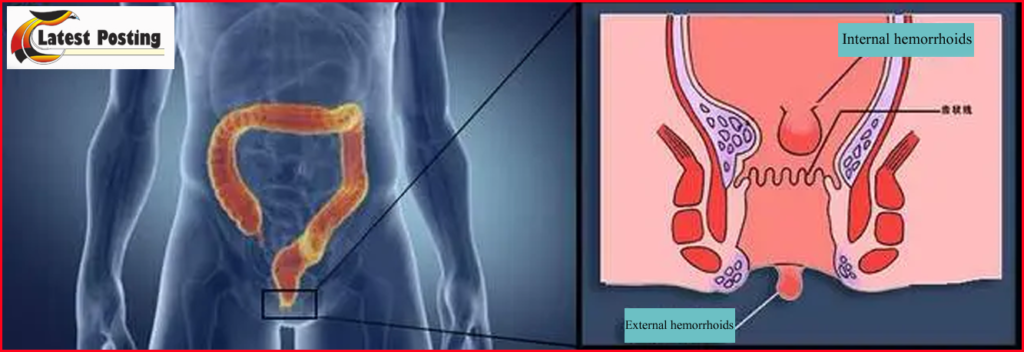 Internal and External hemorrhoids