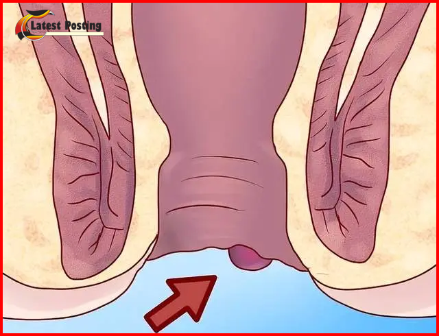 hemorrhoids